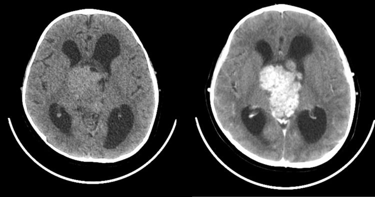 Linfoma cerebral